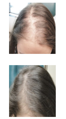 Revifol Hair Loss Review - User Before & After Result