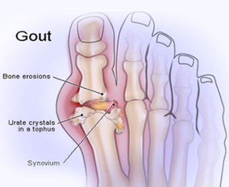 the end of gout pdf free