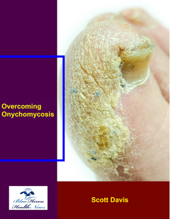 Overcoming Onychomycosis Program