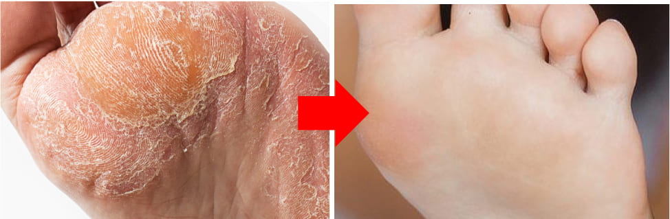 Melzu Foot Peel Mask Before & After Reviews