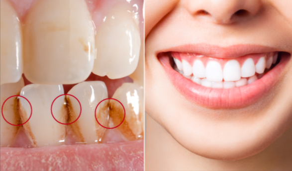 DappSmile Tooth Cleaner Before and After