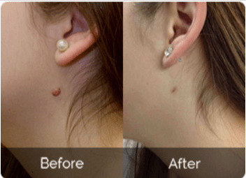 Charm Health Skin Tag Remover benefit