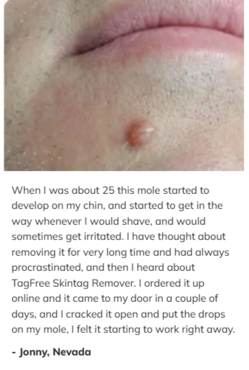 Charm Health Skin Tag Remover customer reviews