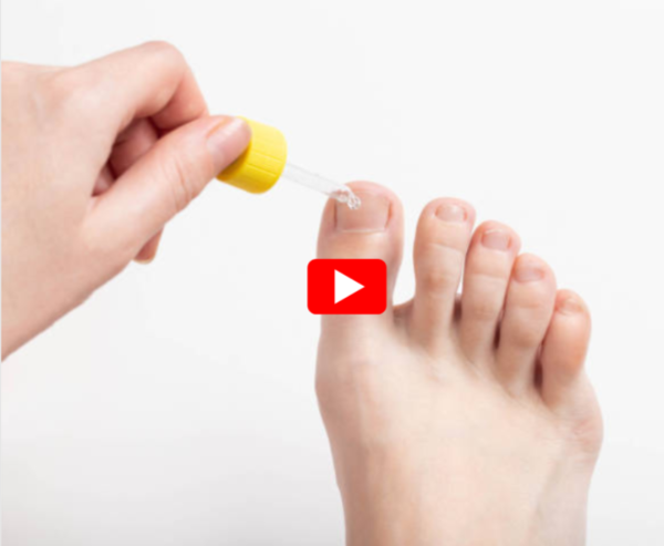 Iodine For Toenail Fungus