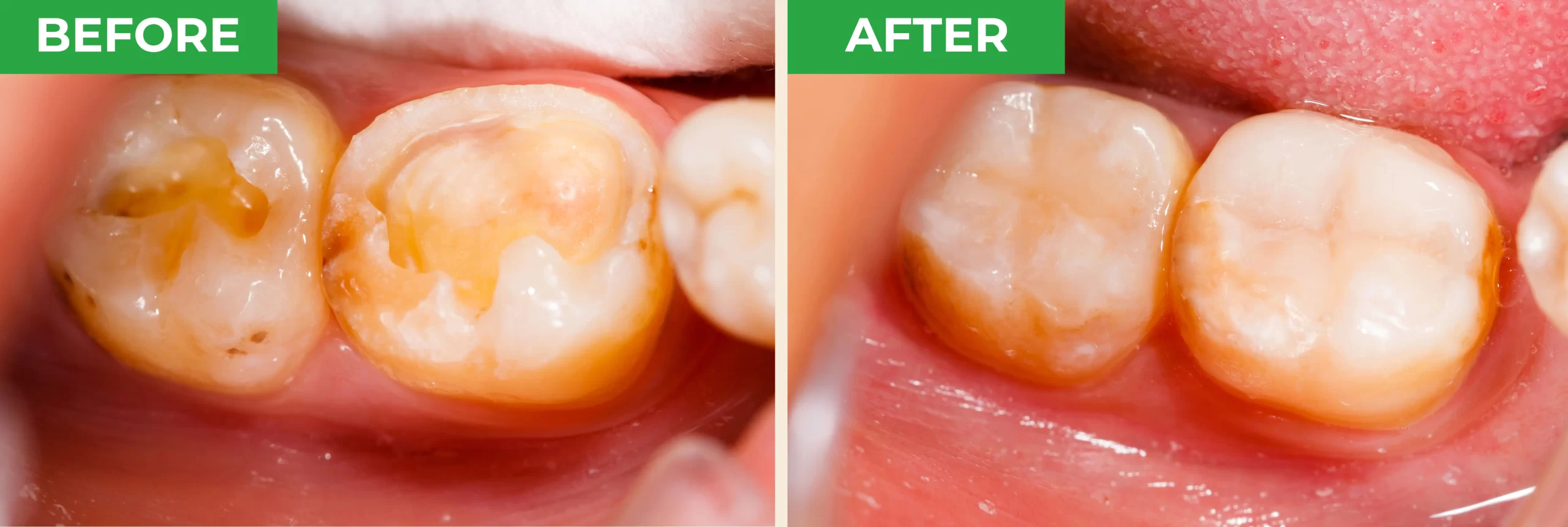 ProXental Benefits