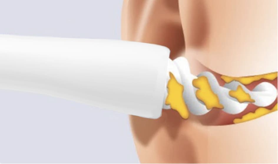 Tvidler Ear Wax Cleaner work